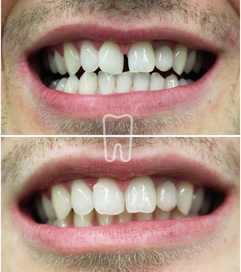 Ispravljanje zuba Inman Alignerom u Ordinaciji Vuić, slučaj prije i poslije