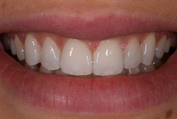 prirodne-ljuskice-za-zube-iskustva-zagreb.jpg.