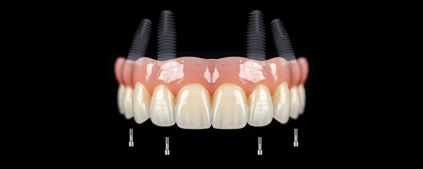 All-on-4/All-on-6 implantati