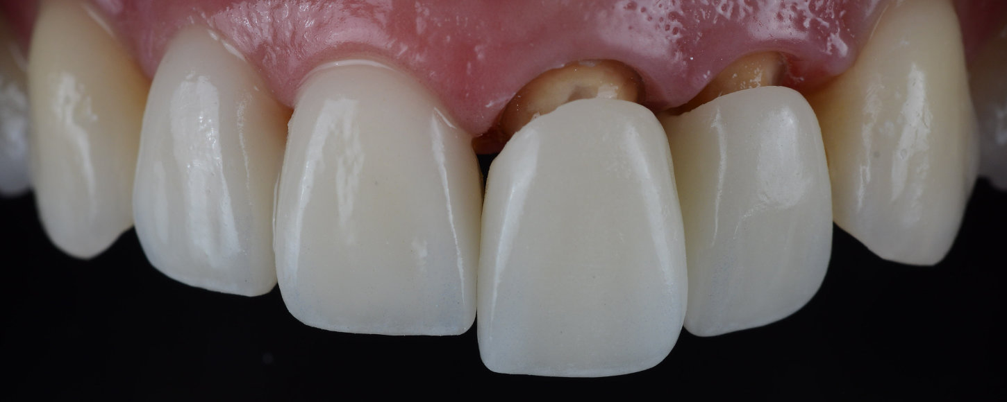 Cirkonske zubne krunice