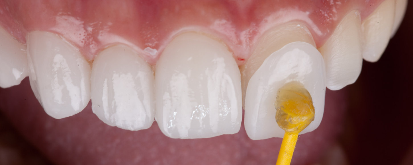 Ljuskice za zube (veneers)