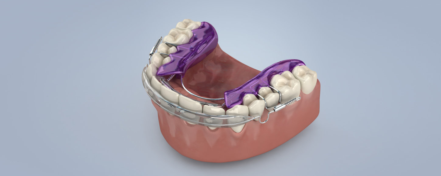 Inman Aligner