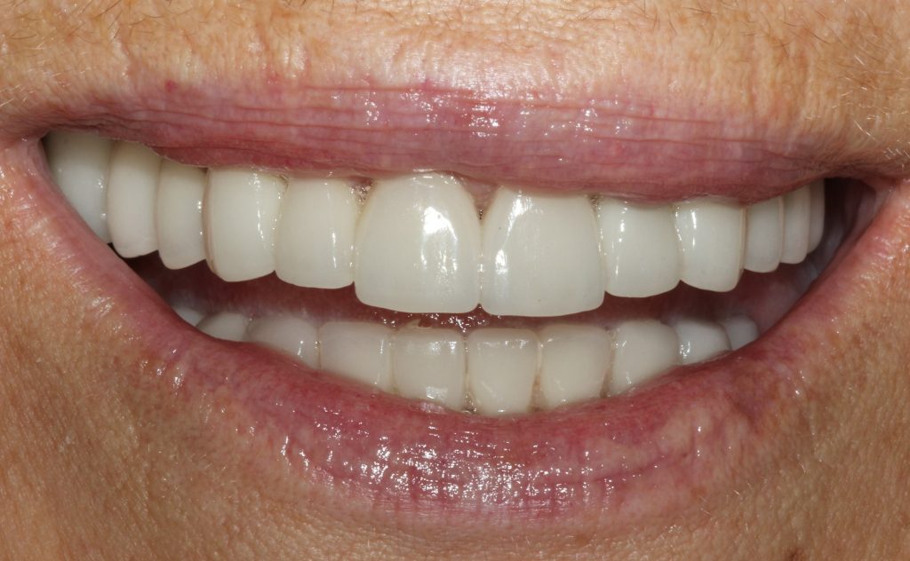 cirkon keramički most