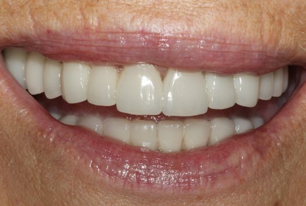 cirkon keramički most